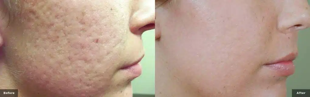 laser genesis before and after 6